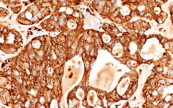 62A Metastasis, Lung adeno (Case 62) Napsin A 40X