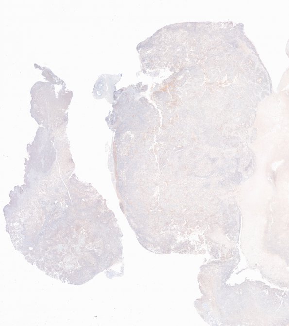 63B Metastasis, lung primary (Case 63) CK 20