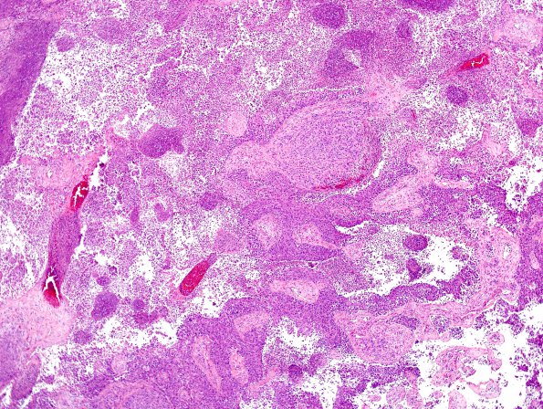 64A1 Metastasis, lung & Marked Rxn (Case 64) D2 H&E 4