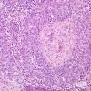 64A2 Metastasis, lung & Marked Rxn (Case 64) H&E 2