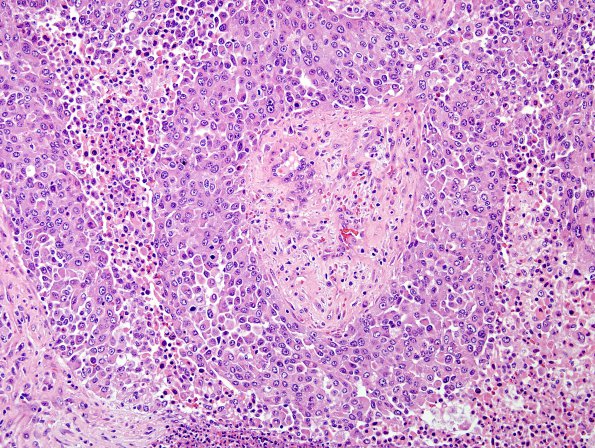 64A2 Metastasis, lung & Marked Rxn (Case 64) H&E 2