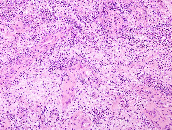 64A3 Metastasis, lung & Marked Rxn (Case 64) B1 H&E 5