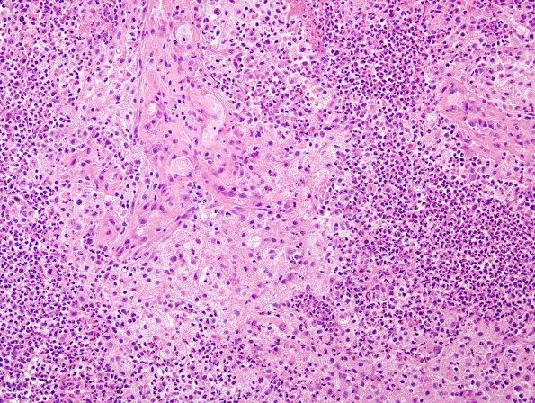 64A4 Metastasis, lung & Marked Rxn (Case 64) B1 H&E 7