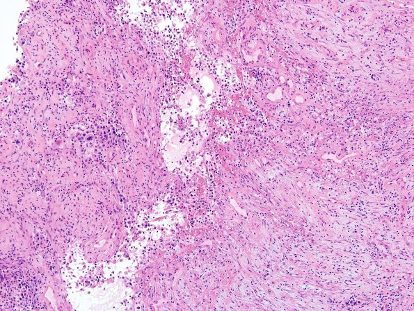 64A5 Metastasis, lung & Marked Rxn (Case 64) A1 H&E 1