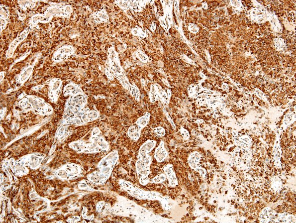 64B Metastasis, lung & Marked Rxn (Case 64) B1 CD68 1