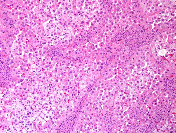 65A1 Metastasis, lung, unusual (Case 65) H&E 4.jpg