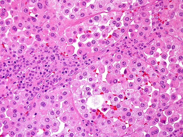 65A2 Metastasis, lung, unusual (Case 65) H&E 3.jpg