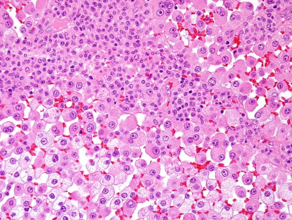 65A3 Metastasis, lung, unusual (Case 65) H&E 7.jpg