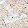 65B Metastasis, lung, unusual (Case 65) Napsin-A 1.jpg