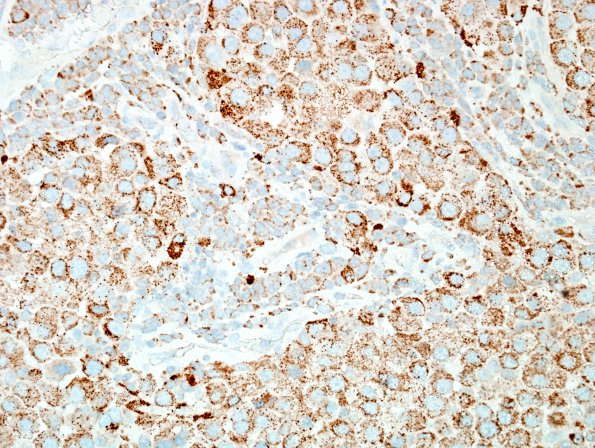 65B Metastasis, lung, unusual (Case 65) Napsin-A 1.jpg