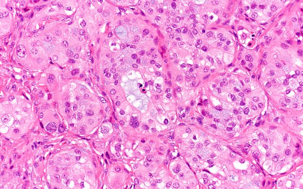 66A1 Metastasis, lung mucoepidermoid (Case 66) 40X