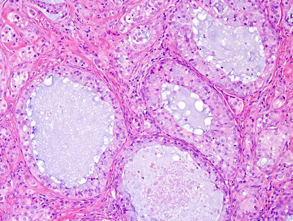 66A2 Metastasis, lung mucoepidermoid (Case 66).jpg