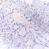 66B2 Metastasis, lung mucoepidermoid (Case 66)) TTF1 20X