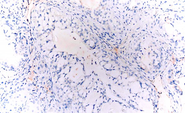 66B2 Metastasis, lung mucoepidermoid (Case 66)) TTF1 20X