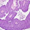 67A1 Metastasis, lung small cell CA (Case 67) H&E 1 - Copy