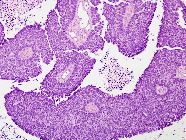 67A1 Metastasis, lung small cell CA (Case 67) H&E 1 - Copy