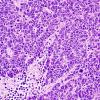 67A2 Metastasis, lung small cell (Case 67) H&E 2 - Copy.jpg