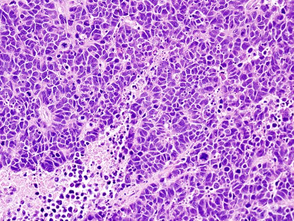 67A2 Metastasis, lung small cell (Case 67) H&E 2 - Copy.jpg