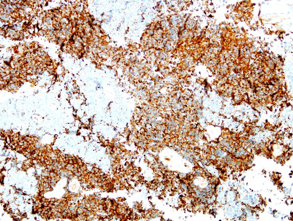 67B1 Metastasis, lung small cell CA (Case 67) CAM5.2 - Copy