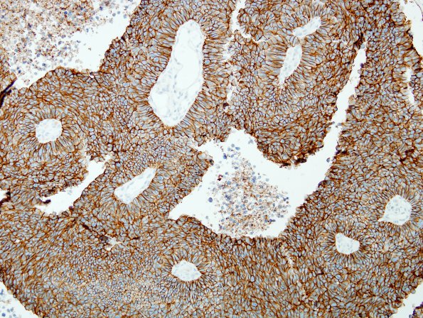 67B2 Metastasis, lung small cell CA (Case 67) CD56