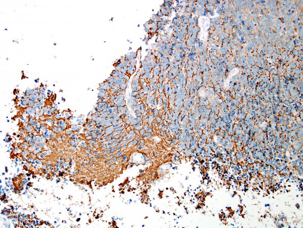 67B3 Metastasis, lung small cell CA (Case 67) SYN - Copy