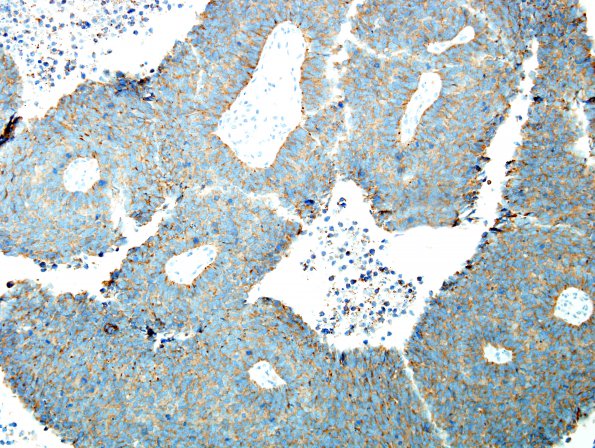 67B4 Metastasis, lung small cell CA (Case 67) SYN 2 - Copy