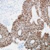 67B5 Metastasis, lung small cell CA (Case 67) TTF-1 - Copy