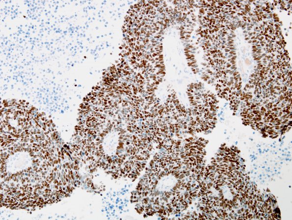 67B5 Metastasis, lung small cell CA (Case 67) TTF-1 - Copy