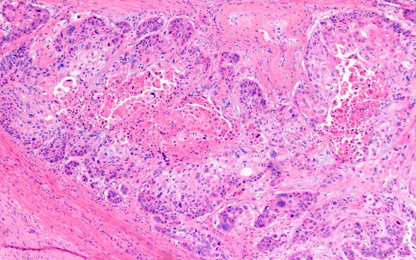 68A1 Metastasis, lung squamous (Case 68) H&E 10X