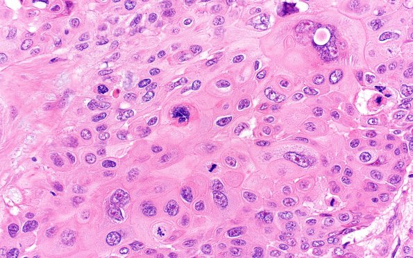 68A2 Metastasis, lung squamous (Case 68) H&E 40X