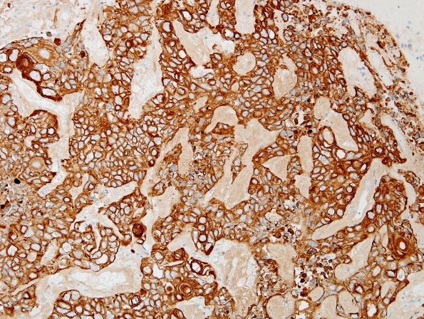 68B1 Metastasis, lung squamous (Case 68) CK.jpg