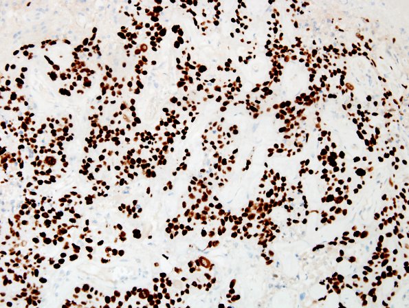 68B2 Metastasis, lung squamous (Case 68) p40.jpg