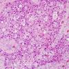 69A Metastasis, lung squamous (p40 ) (Case 69) 2.jpg