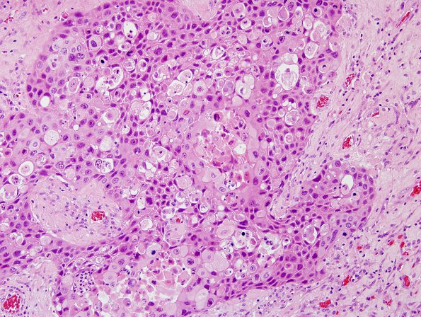 69A Metastasis, lung squamous (p40 ) (Case 69) 2.jpg