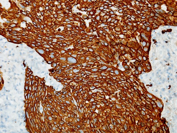 69B Metastasis, lung squamous (Case 69) CK5-6.jpg