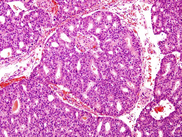 6A1 Metastasis, prostate (Case 6) H&E 1