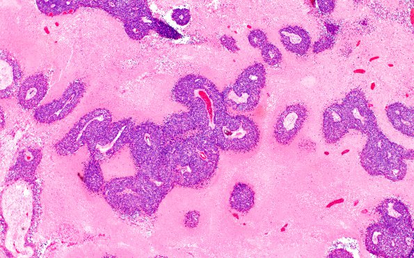 70A1 Metastasis, lung, squamous cell CA (Case 70) H&E 4X