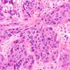 70A2 Metastasis, lung, squamous cell CA (Case 70) H&E 2