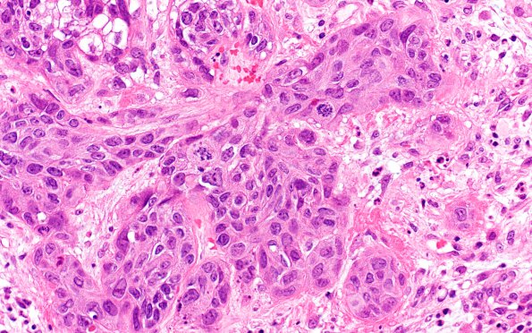 70A2 Metastasis, lung, squamous cell CA (Case 70) H&E 2