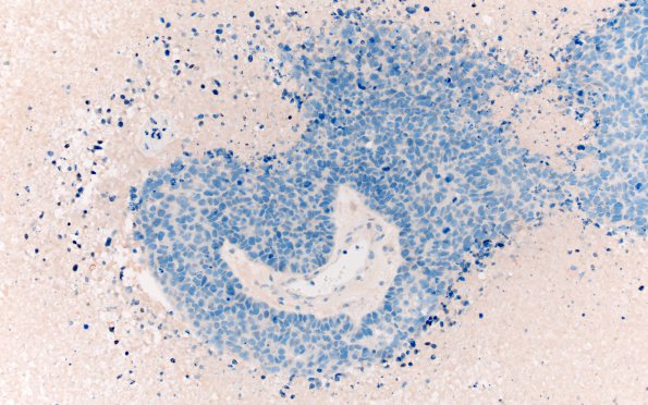 70B Metastasis, lung, squamous cell CA (Case 70) NapsinA