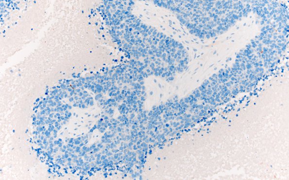 70C Metastasis, lung, squamous cell CA (Case 70) SYN 1