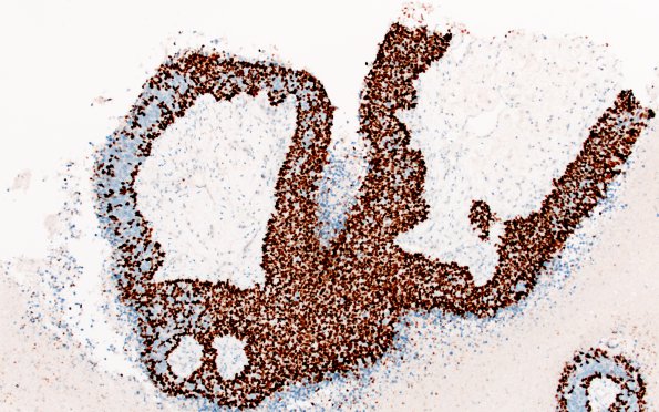 70E Metastasis, lung, squamous cell CA (Case 70) p40