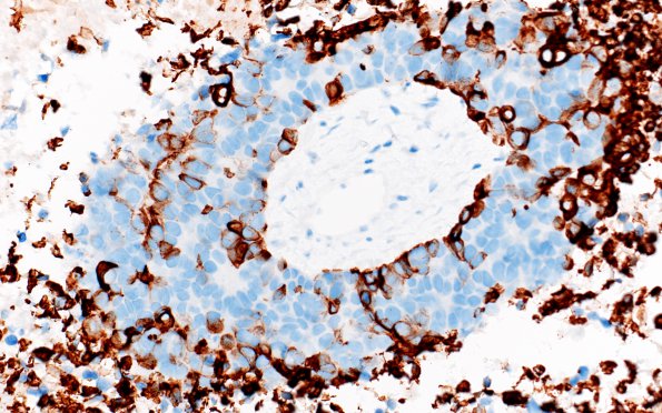 70F Metastasis, lung, squamous cell CA (Case 70) CK5-6 1