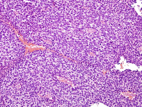 71A1 Metastasis, lung, small cell CA (Case 71) H&E 1