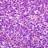 71A2 Metastasis, lung, small cell CA (Case 71) H&E 2 - Copy