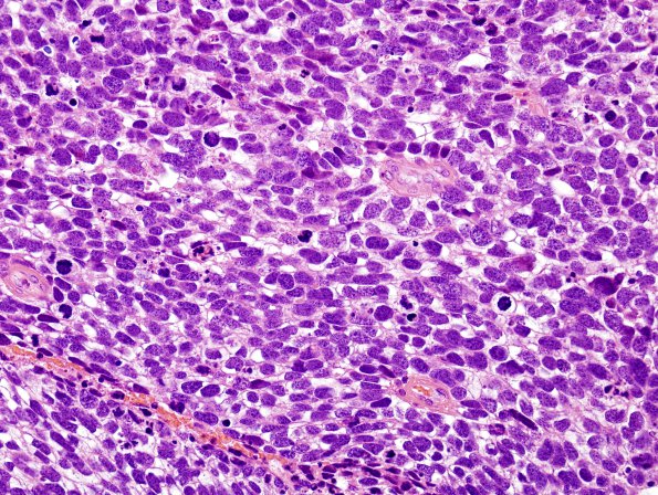 71A2 Metastasis, lung, small cell CA (Case 71) H&E 2 - Copy