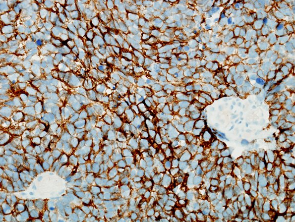 71B Metastasis, lung, small cell CA (Case 71) CK7 - Copy