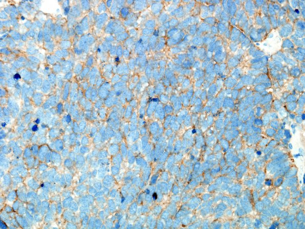 71C Metastasis, lung, small cell CA (Case 71) SYN