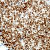 71D Metastasis, lung, small cell CA (Case 71) TTF-1 - Copy