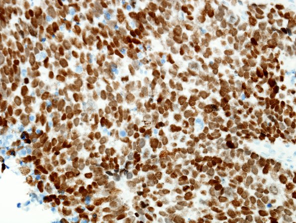 71D Metastasis, lung, small cell CA (Case 71) TTF-1 - Copy